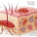Scabies Treatment